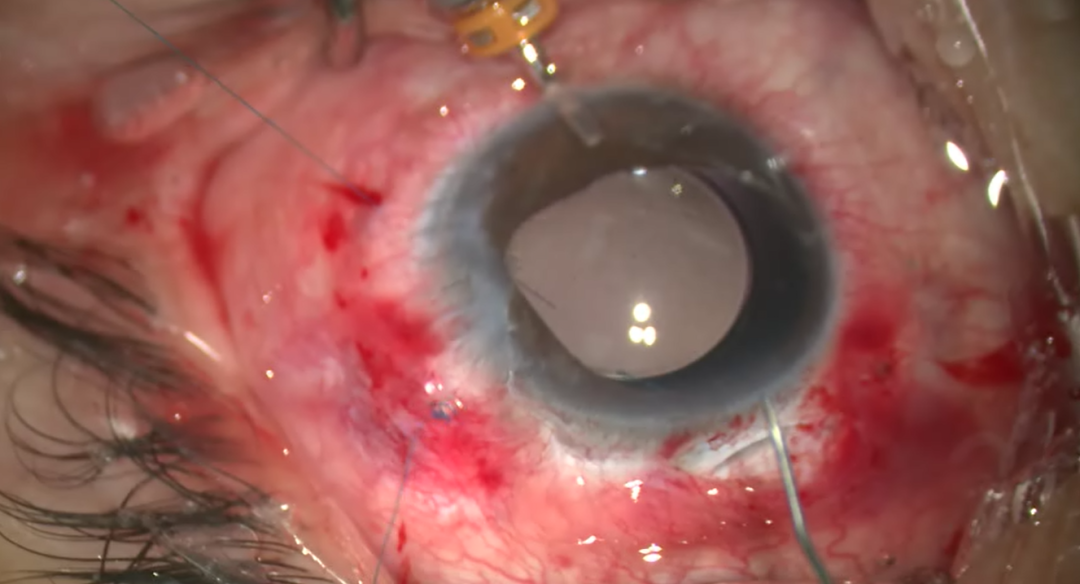 开睑器怎么用术说睛彩 ｜ 金海鹰教授：使用8-0缝线的无巩膜瓣人工晶体固定手术_https://www.jmylbn.com_新闻资讯_第20张