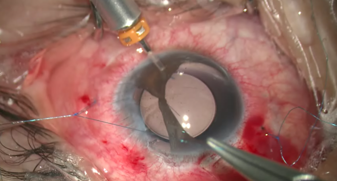 开睑器怎么用术说睛彩 ｜ 金海鹰教授：使用8-0缝线的无巩膜瓣人工晶体固定手术_https://www.jmylbn.com_新闻资讯_第13张