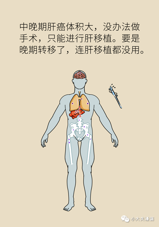 世界肝炎日：肝癌早期可治愈，篩查又有黑科技 健康 第11張