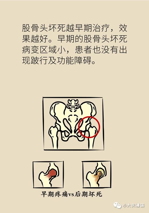 使用過激素，股骨頭就會走向壞死的深淵嗎？專家告訴你該怎麼辦！ 健康 第21張