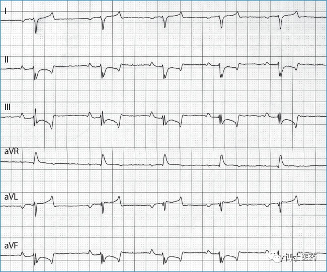 ecg导联脱落怎么办常见ECG导联连接异常分析_https://www.jmylbn.com_新闻资讯_第16张