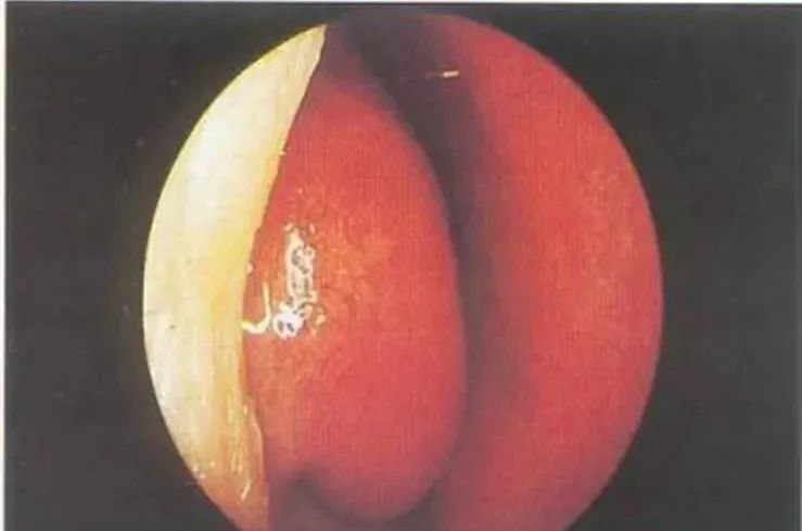 你有没有这些引发鼻炎的坏习惯?