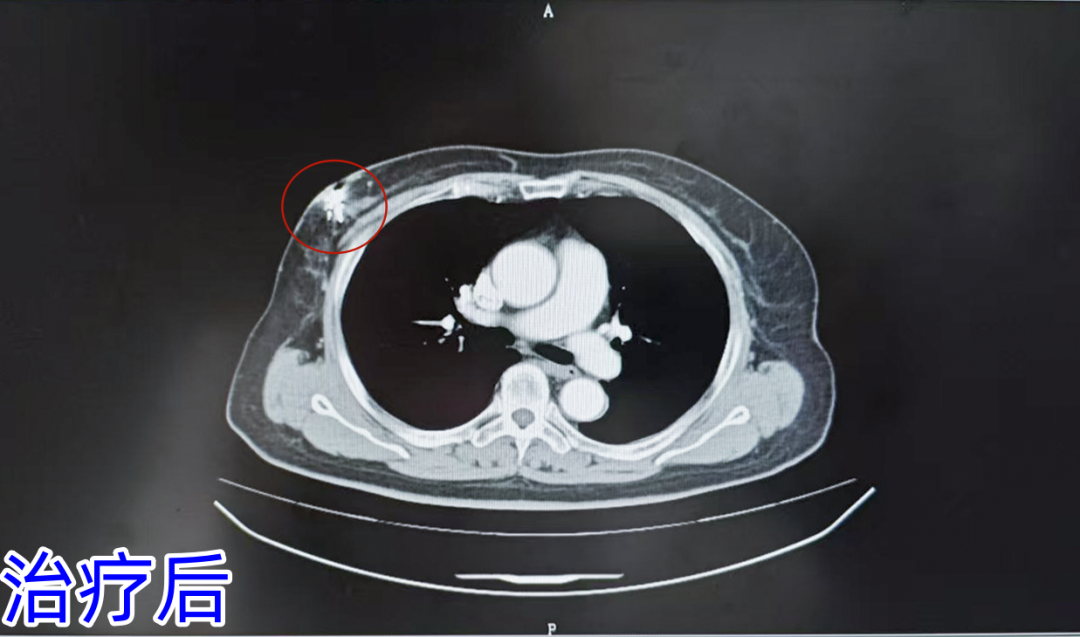 治疗后.png