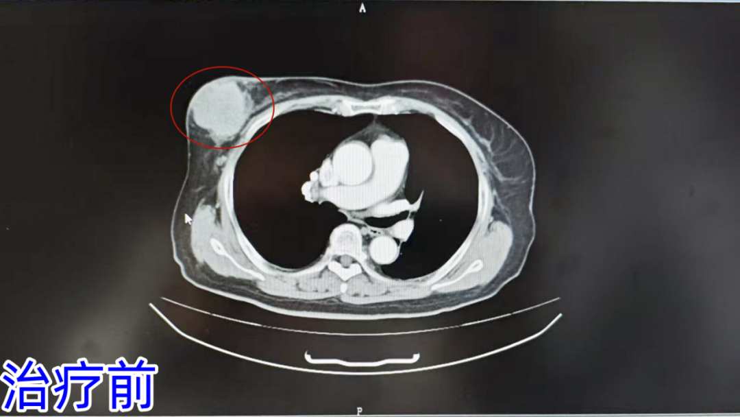 治疗前.png