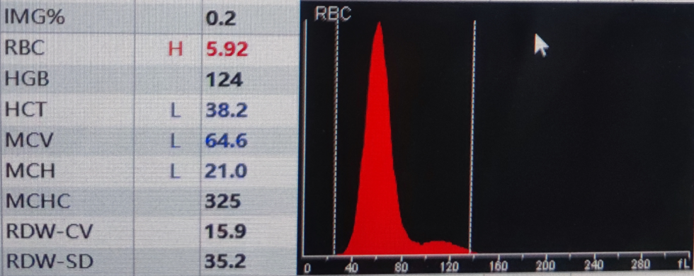 rbc直方图怎么看红细胞增多如何解读？红细胞直方图怎么看？看这篇就够了_https://www.jmylbn.com_新闻资讯_第6张
