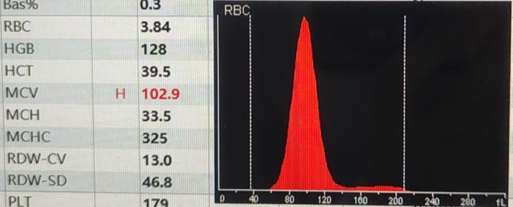 rbc直方图怎么看红细胞增多如何解读？红细胞直方图怎么看？看这篇就够了_https://www.jmylbn.com_新闻资讯_第10张