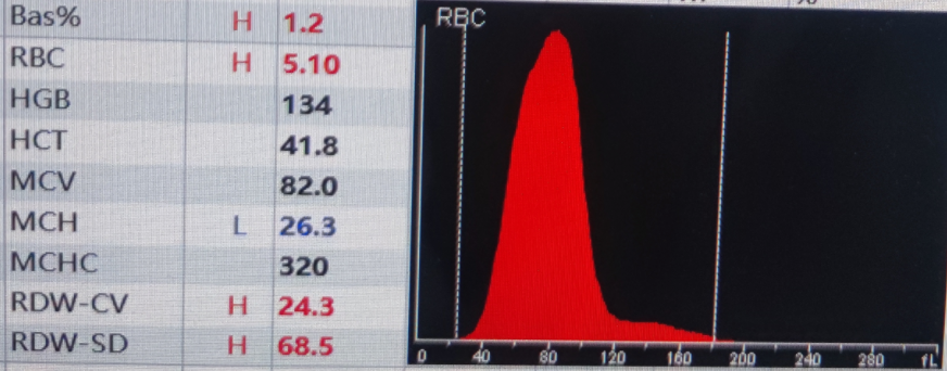 rbc直方图怎么看红细胞增多如何解读？红细胞直方图怎么看？看这篇就够了_https://www.jmylbn.com_新闻资讯_第8张