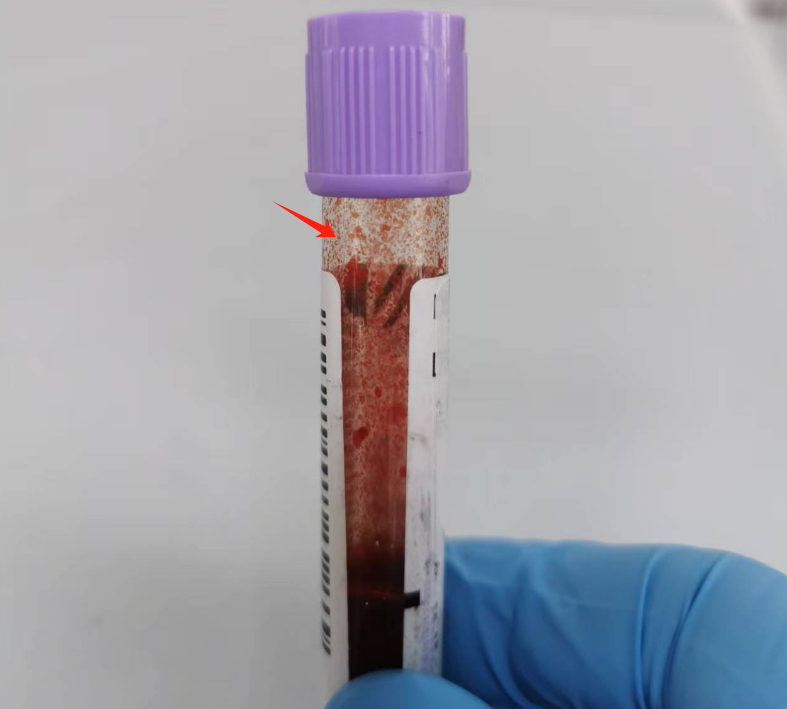 rbc直方图怎么看血常规审核：「三三原则」从哪来？怎么用？这篇说明白了_https://www.jmylbn.com_新闻资讯_第9张