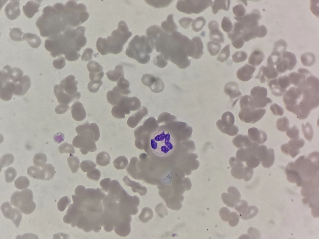 rbc直方图怎么看血常规审核：「三三原则」从哪来？怎么用？这篇说明白了_https://www.jmylbn.com_新闻资讯_第10张