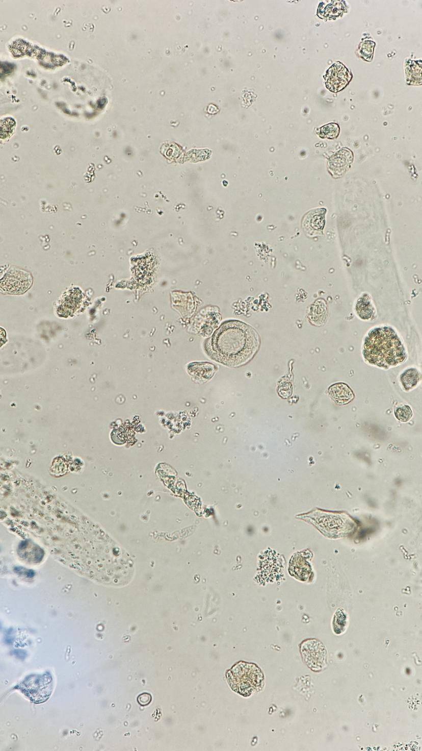 上皮细胞用什么染色尿液中 10 种上皮细胞镜检形态汇总，图片收集全啦！_https://www.jmylbn.com_新闻资讯_第11张