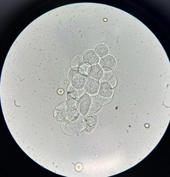 上皮细胞用什么染色尿液中 10 种上皮细胞镜检形态汇总，图片收集全啦！_https://www.jmylbn.com_新闻资讯_第9张