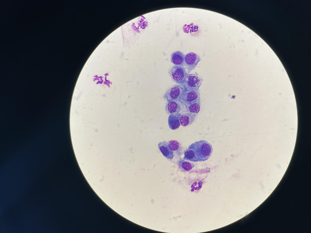 上皮细胞用什么染色尿液中 10 种上皮细胞镜检形态汇总，图片收集全啦！_https://www.jmylbn.com_新闻资讯_第20张