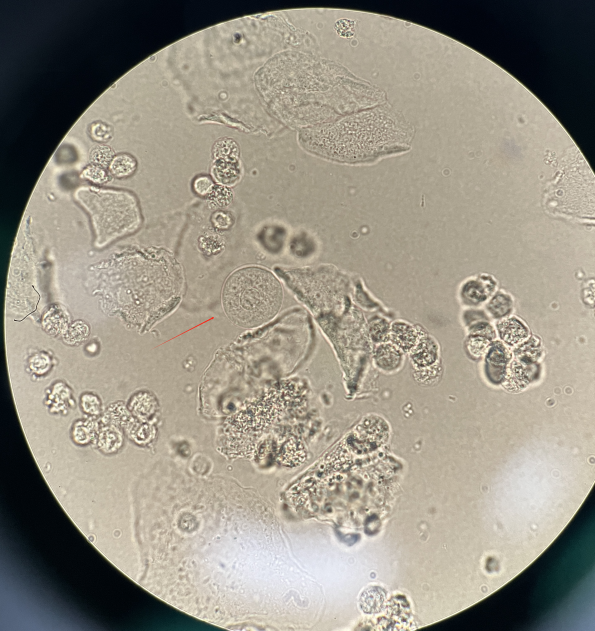 上皮细胞用什么染色尿液中 10 种上皮细胞镜检形态汇总，图片收集全啦！_https://www.jmylbn.com_新闻资讯_第3张