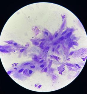 上皮细胞用什么染色尿液中 10 种上皮细胞镜检形态汇总，图片收集全啦！_https://www.jmylbn.com_新闻资讯_第6张