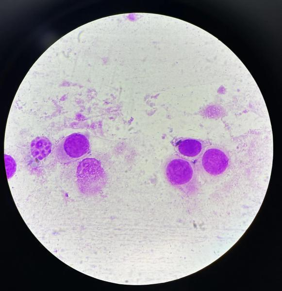 上皮细胞用什么染色尿液中 10 种上皮细胞镜检形态汇总，图片收集全啦！_https://www.jmylbn.com_新闻资讯_第18张