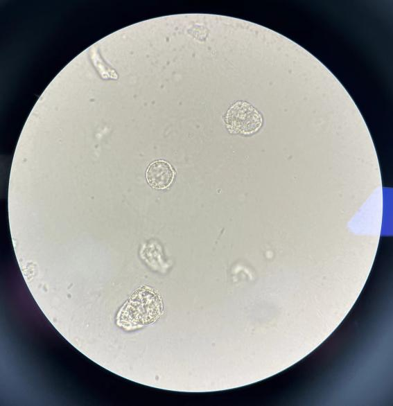 上皮细胞用什么染色尿液中 10 种上皮细胞镜检形态汇总，图片收集全啦！_https://www.jmylbn.com_新闻资讯_第16张