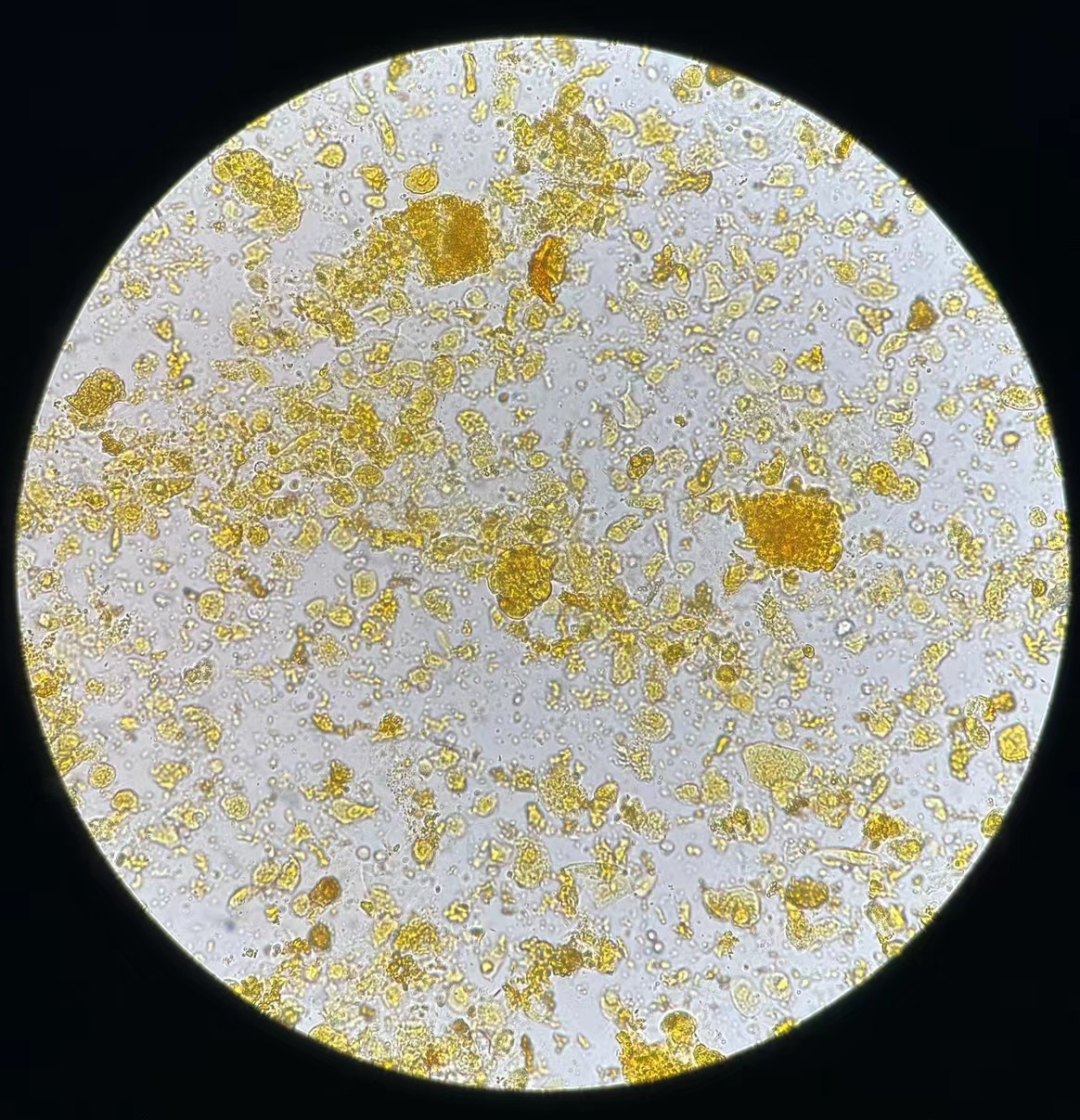 上皮细胞用什么染色尿液中 10 种上皮细胞镜检形态汇总，图片收集全啦！_https://www.jmylbn.com_新闻资讯_第12张