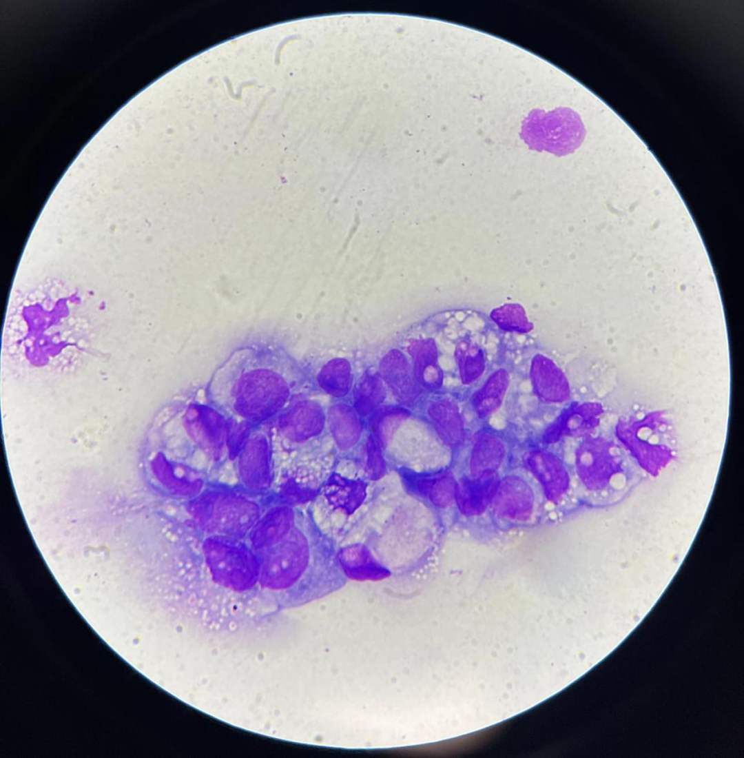 上皮细胞用什么染色尿液中 10 种上皮细胞镜检形态汇总，图片收集全啦！_https://www.jmylbn.com_新闻资讯_第21张