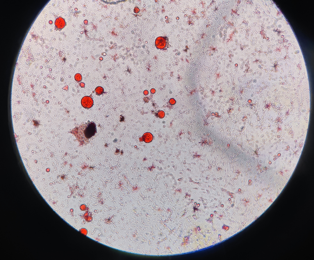 上皮细胞用什么染色尿液中 10 种上皮细胞镜检形态汇总，图片收集全啦！_https://www.jmylbn.com_新闻资讯_第15张