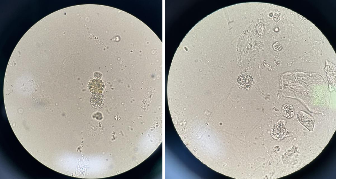上皮细胞用什么染色尿液中 10 种上皮细胞镜检形态汇总，图片收集全啦！_https://www.jmylbn.com_新闻资讯_第14张