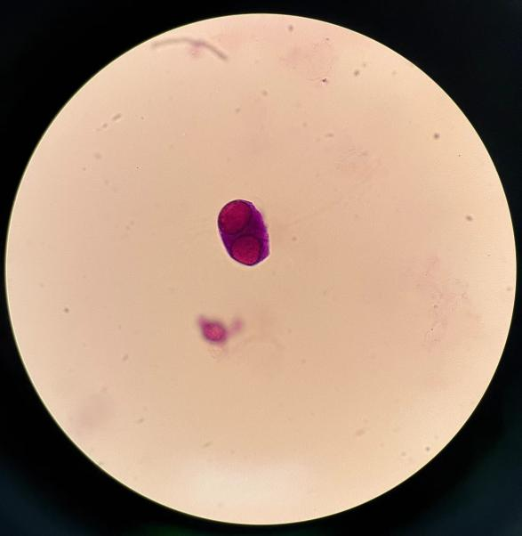 上皮细胞用什么染色尿液中 10 种上皮细胞镜检形态汇总，图片收集全啦！_https://www.jmylbn.com_新闻资讯_第17张