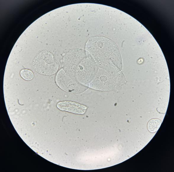 上皮细胞用什么染色尿液中 10 种上皮细胞镜检形态汇总，图片收集全啦！_https://www.jmylbn.com_新闻资讯_第10张