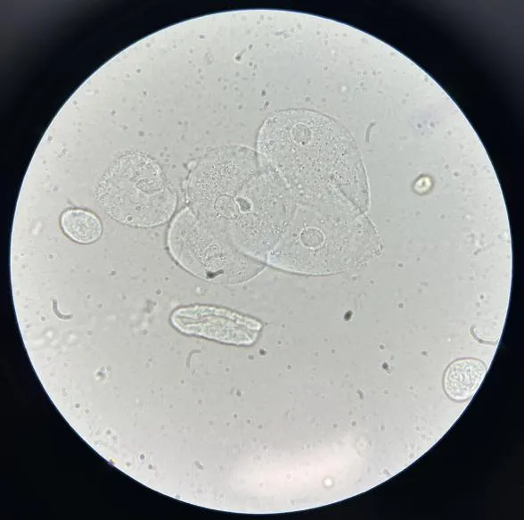 上皮细胞用什么染色尿液中 10 种上皮细胞镜检形态汇总,图片收集全啦!_新闻资讯_第10张_活检穿刺产品网 上皮细胞用什么染色尿液中 10 种上皮细胞镜检形态汇总,图片收集全啦!_https://www.jmylbn.com_新闻资讯_第10张