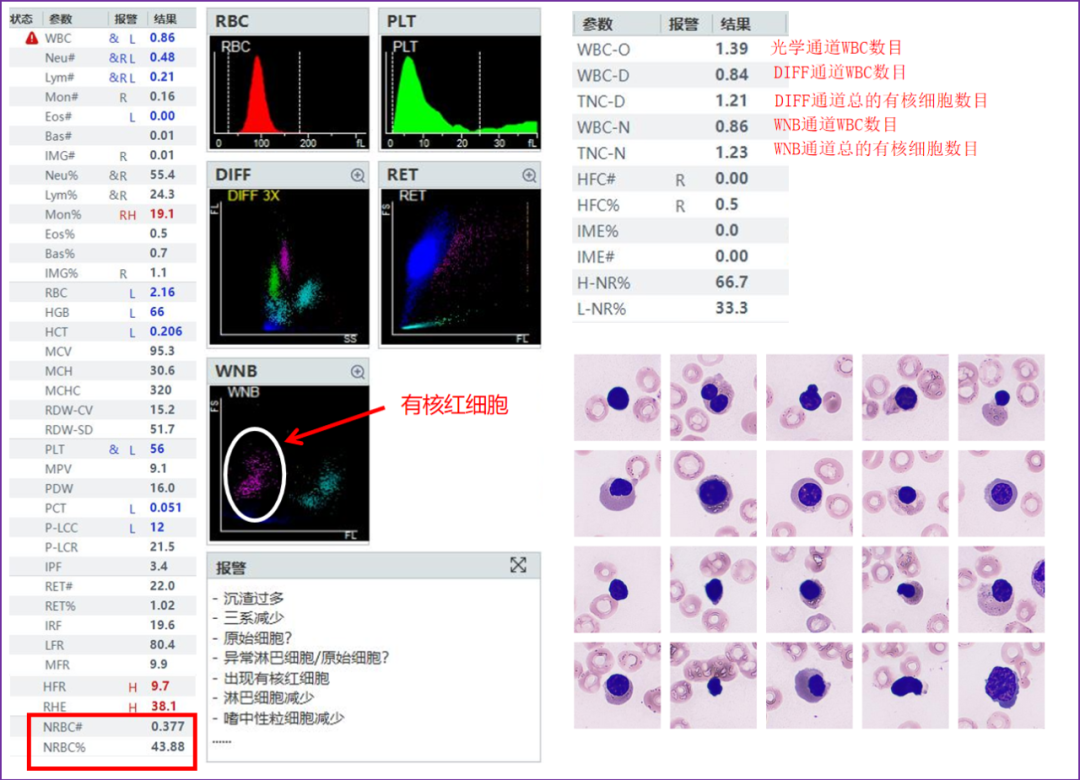rbc直方图怎么看遇到异常标本，血常规怎么做？看这篇就够了_https://www.jmylbn.com_新闻资讯_第10张