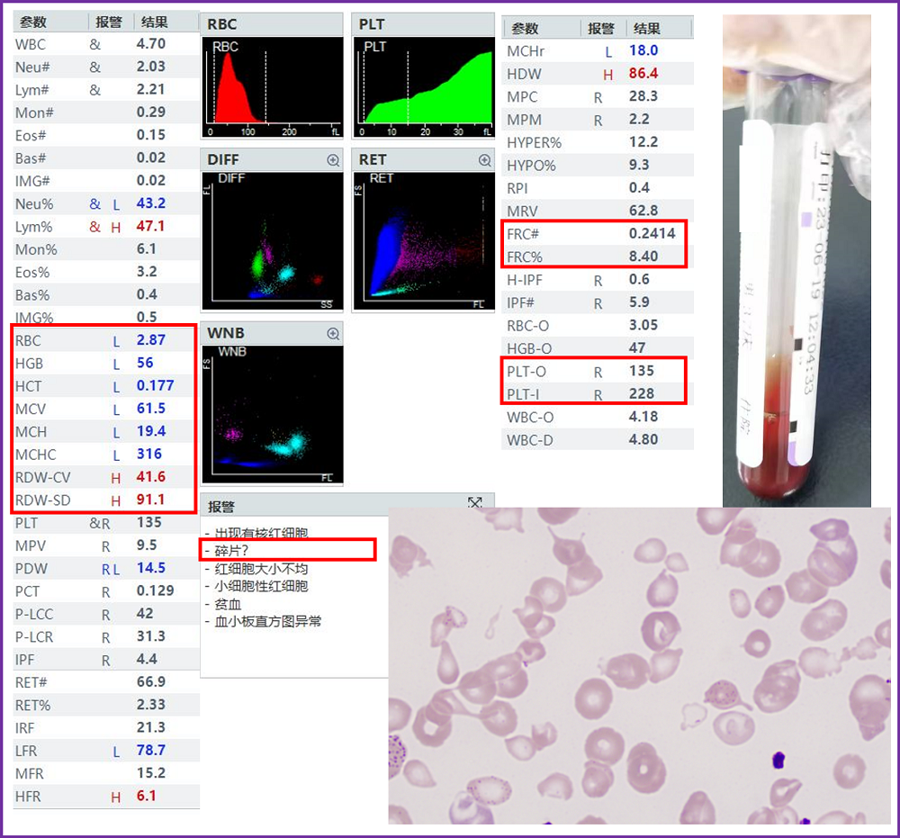 rbc直方图怎么看遇到异常标本，血常规怎么做？看这篇就够了_https://www.jmylbn.com_新闻资讯_第2张