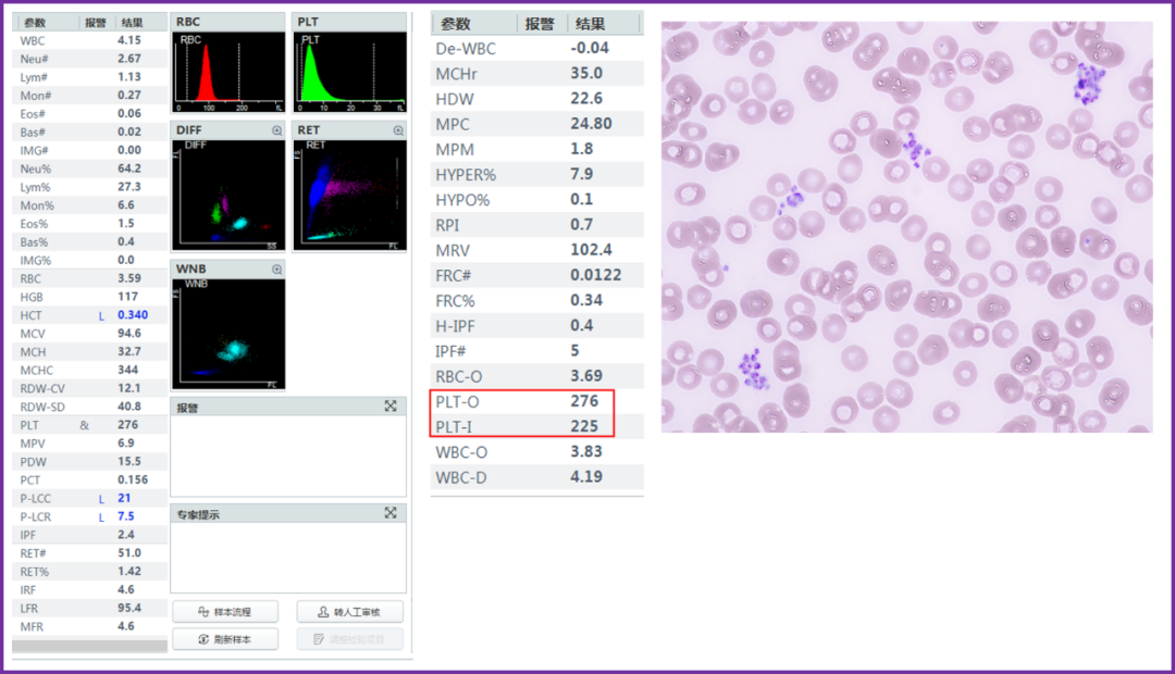 rbc直方图怎么看遇到异常标本，血常规怎么做？看这篇就够了_https://www.jmylbn.com_新闻资讯_第9张