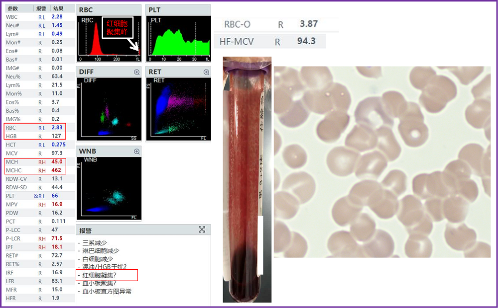 rbc直方图怎么看遇到异常标本，血常规怎么做？看这篇就够了_https://www.jmylbn.com_新闻资讯_第3张