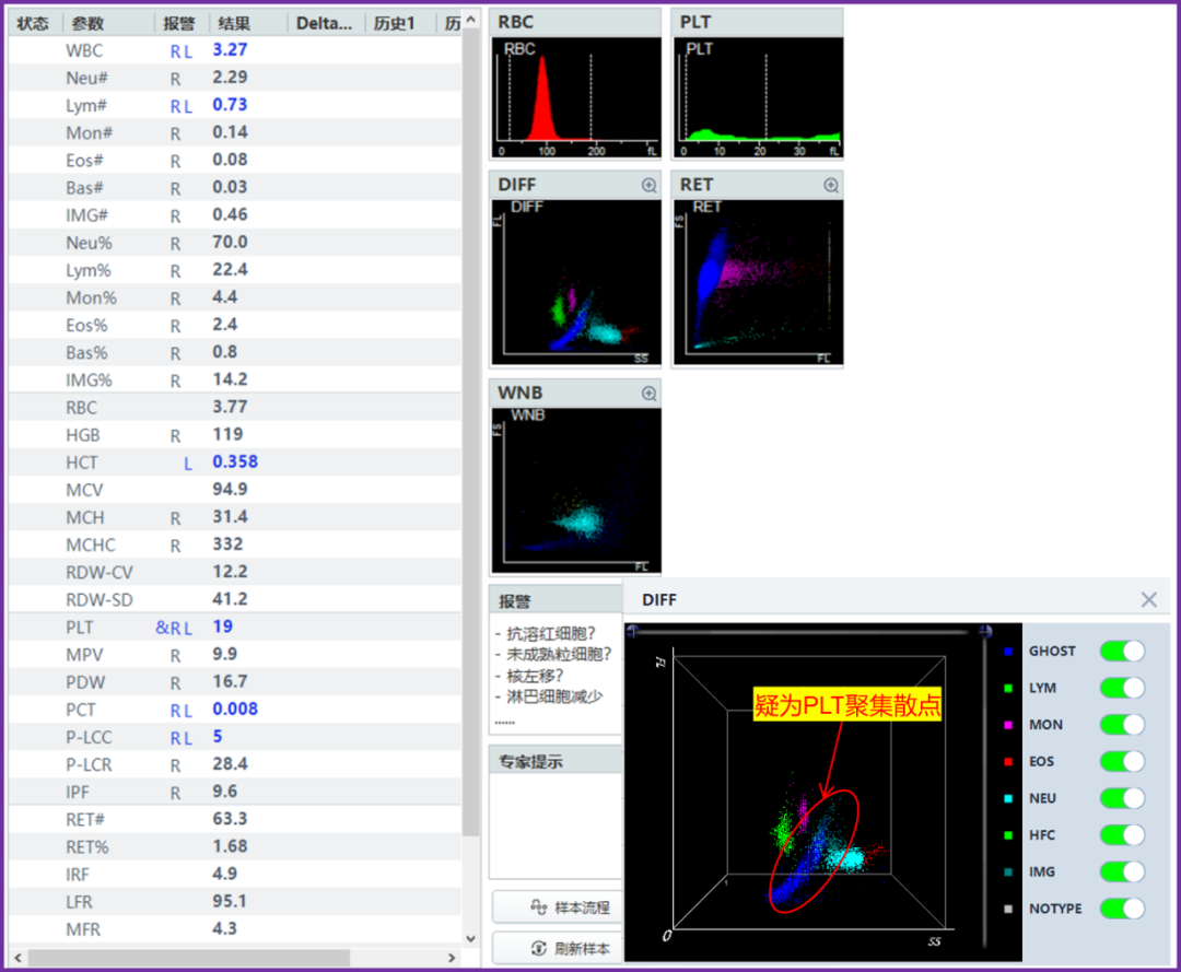 rbc直方图怎么看遇到异常标本，血常规怎么做？看这篇就够了_https://www.jmylbn.com_新闻资讯_第6张
