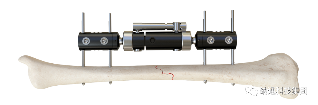 骨折固定有哪些产品正天外固定支架产品，微创治疗多种创伤骨折_https://www.jmylbn.com_新闻资讯_第11张