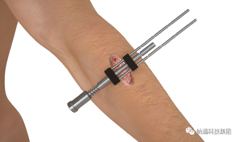 骨折固定有哪些产品正天外固定支架产品，微创治疗多种创伤骨折_https://www.jmylbn.com_新闻资讯_第20张