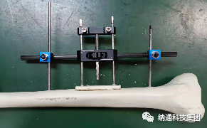 骨折固定有哪些产品正天外固定支架产品，微创治疗多种创伤骨折_https://www.jmylbn.com_新闻资讯_第18张