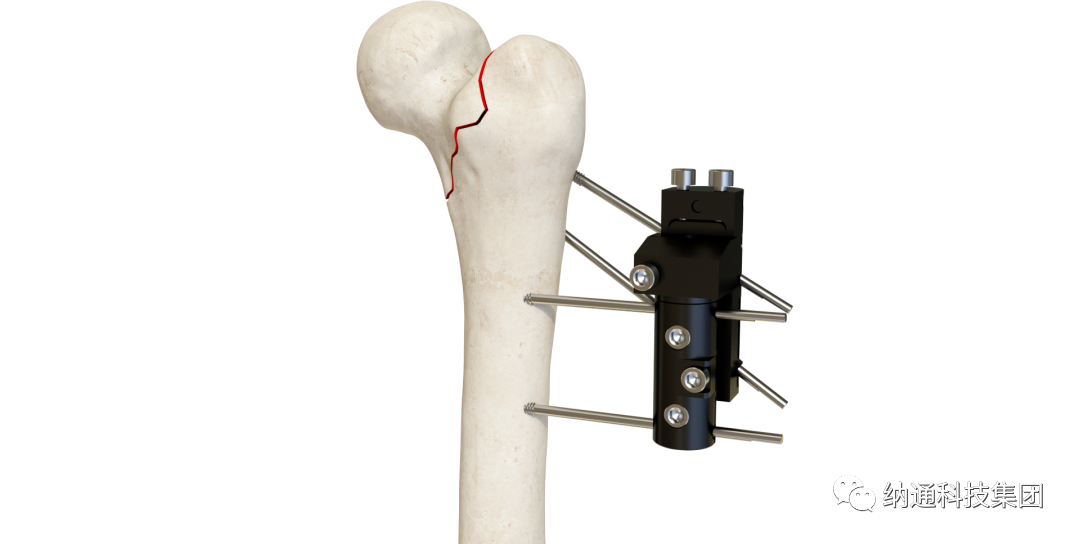 骨折固定有哪些产品正天外固定支架产品，微创治疗多种创伤骨折_https://www.jmylbn.com_新闻资讯_第9张