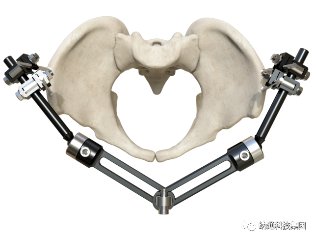 骨折固定有哪些产品正天外固定支架产品，微创治疗多种创伤骨折_https://www.jmylbn.com_新闻资讯_第8张