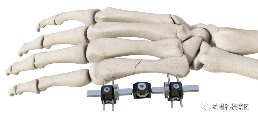 骨折固定有哪些产品正天外固定支架产品，微创治疗多种创伤骨折_https://www.jmylbn.com_新闻资讯_第5张