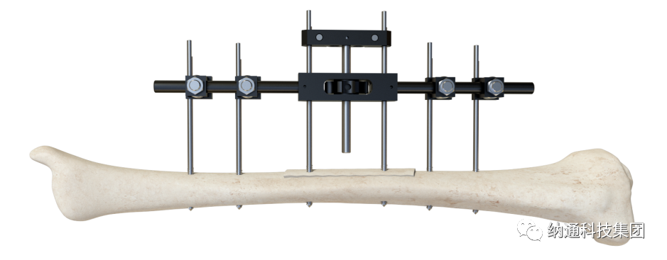 骨折固定有哪些产品正天外固定支架产品，微创治疗多种创伤骨折_https://www.jmylbn.com_新闻资讯_第16张