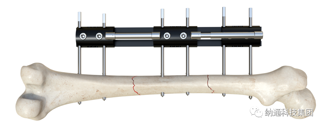 骨折固定有哪些产品正天外固定支架产品，微创治疗多种创伤骨折_https://www.jmylbn.com_新闻资讯_第10张