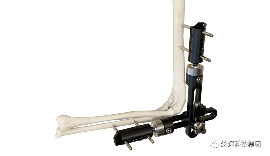 骨折固定有哪些产品正天外固定支架产品，微创治疗多种创伤骨折_https://www.jmylbn.com_新闻资讯_第3张