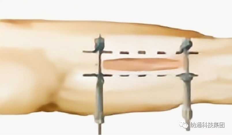 骨折固定有哪些产品正天外固定支架产品，微创治疗多种创伤骨折_https://www.jmylbn.com_新闻资讯_第22张