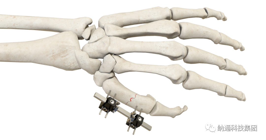 骨折固定有哪些产品正天外固定支架产品，微创治疗多种创伤骨折_https://www.jmylbn.com_新闻资讯_第6张