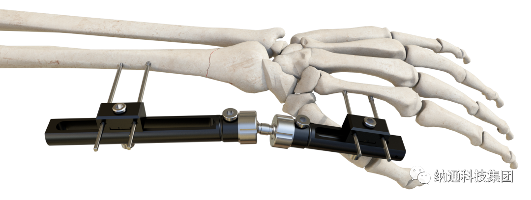 骨折固定有哪些产品正天外固定支架产品，微创治疗多种创伤骨折_https://www.jmylbn.com_新闻资讯_第4张