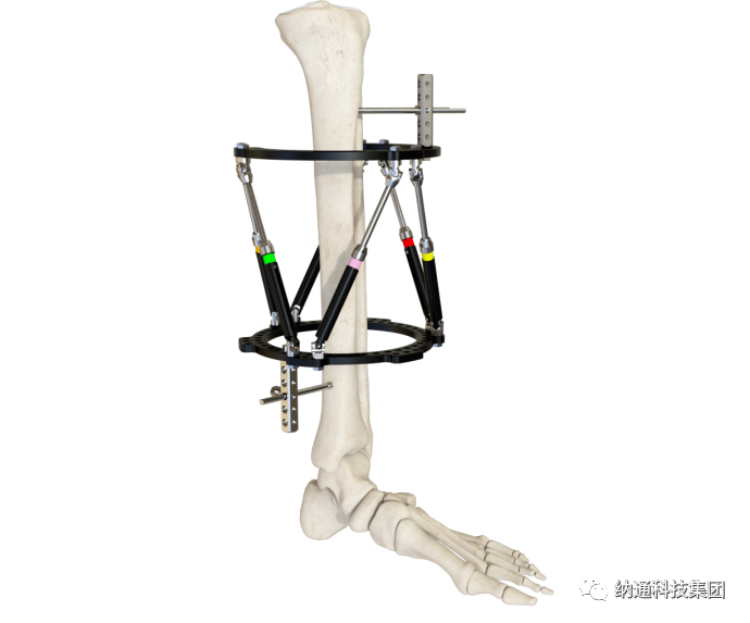 骨折固定有哪些产品正天外固定支架产品，微创治疗多种创伤骨折_https://www.jmylbn.com_新闻资讯_第12张