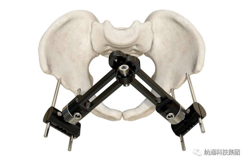 骨折固定有哪些产品正天外固定支架产品，微创治疗多种创伤骨折_https://www.jmylbn.com_新闻资讯_第7张