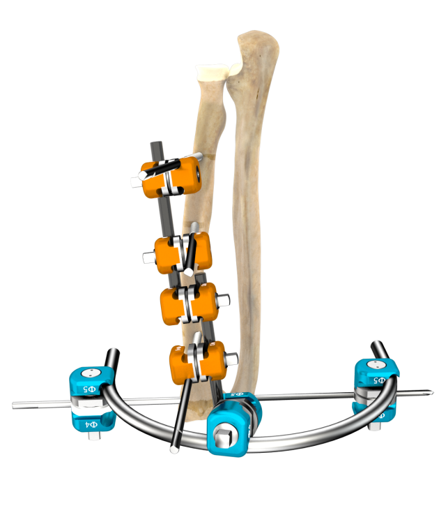 骨折固定有哪些产品正天外固定支架产品，微创治疗多种创伤骨折_https://www.jmylbn.com_新闻资讯_第26张