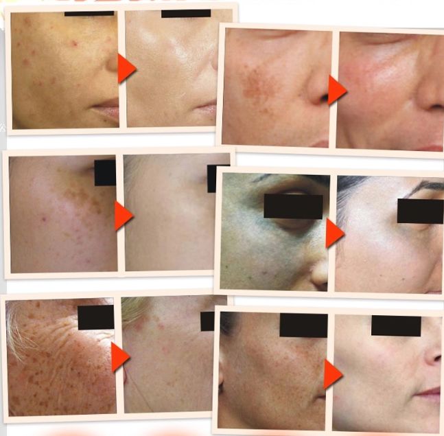 38歲全智賢美到犯規 只因白到發光 歐洲no 1美白霜 連胎記都去無蹤 爸媽營 微文庫