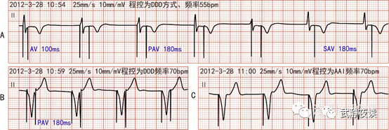 心电图器怎么用双腔起搏器的起搏导线反接时心电图表现_https://www.jmylbn.com_新闻资讯_第2张