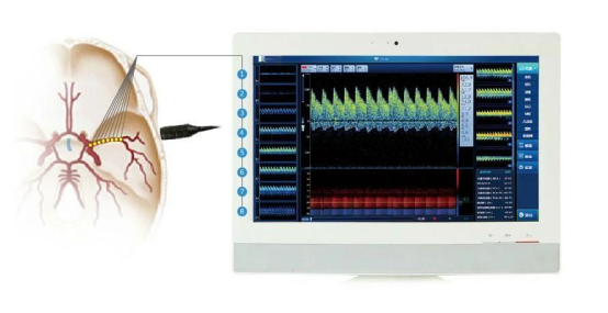 彩色经颅多普勒是什么【健康科普】经颅多普勒超声（TCD）——看透你的脑！_https://www.jmylbn.com_新闻资讯_第6张